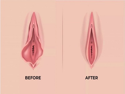 Labiaplasty Treatment in Delhi